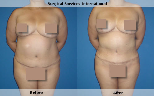 Liposuction, full body